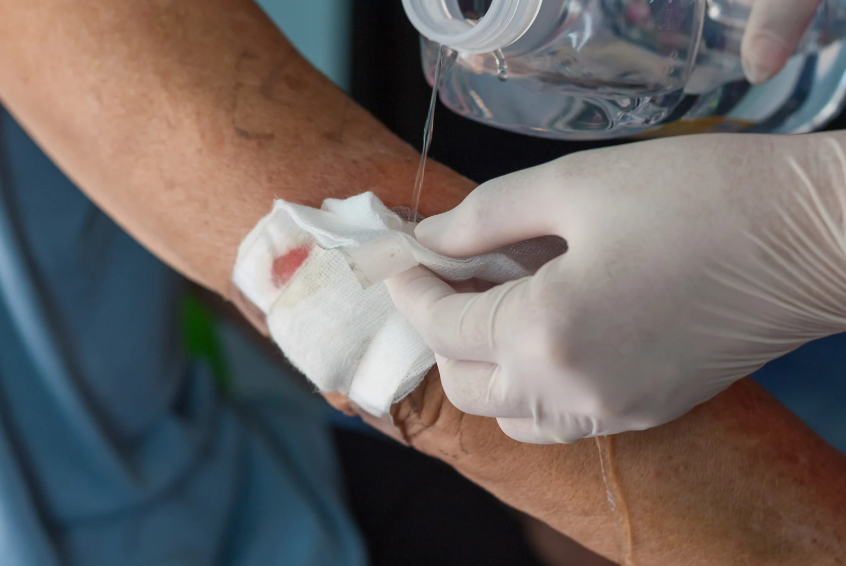 Best wound debridement Philippines