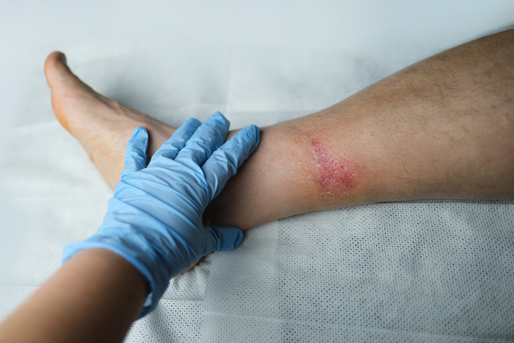 Expert Care Seeing a Doctor for Infected Wounds