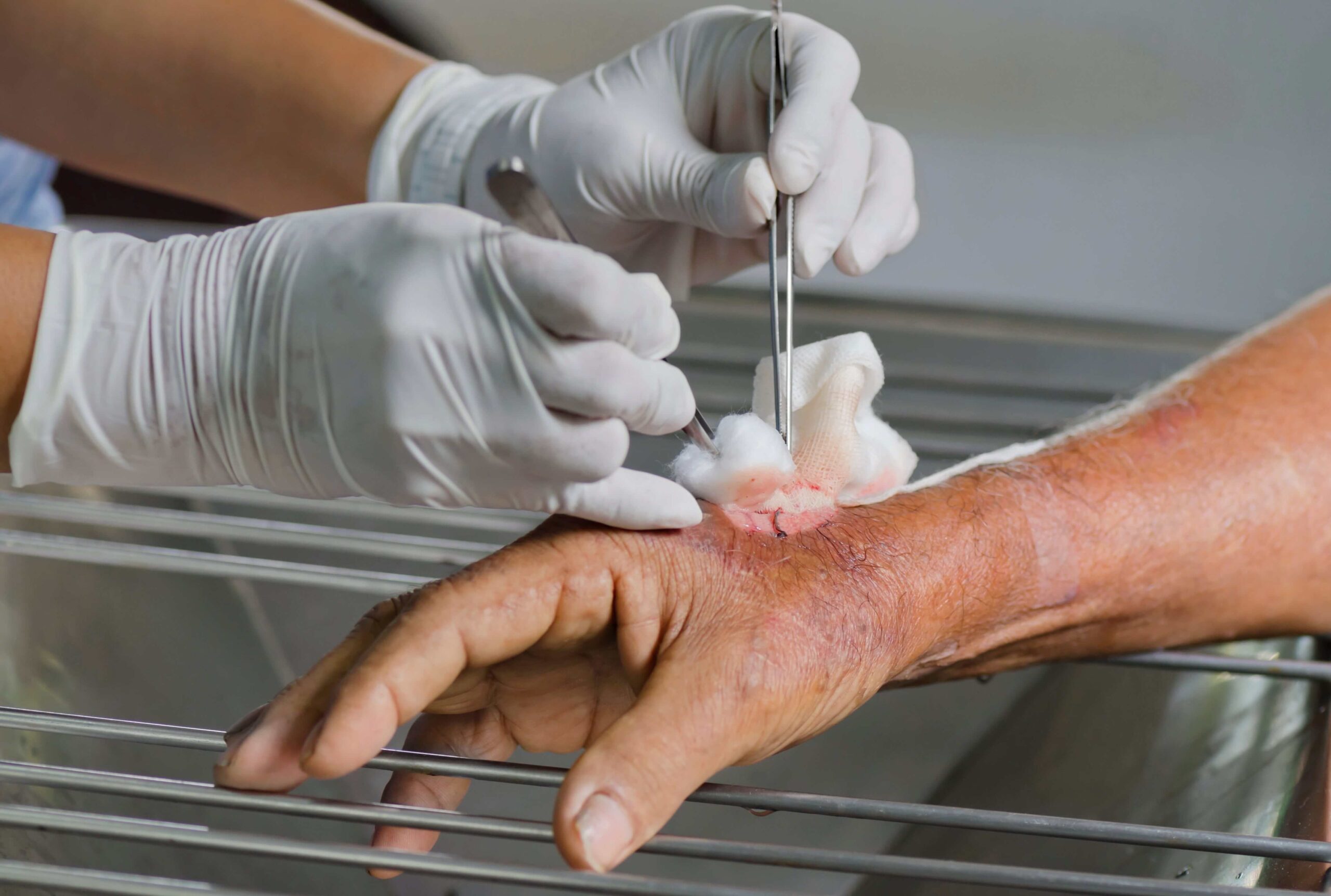 Wound Debridement Services Essential Care for Faster Healing