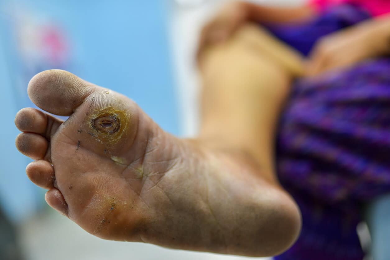 Orthopedic Treatment for Diabetic Gangrene Approaches, Strategies, and Patient Care