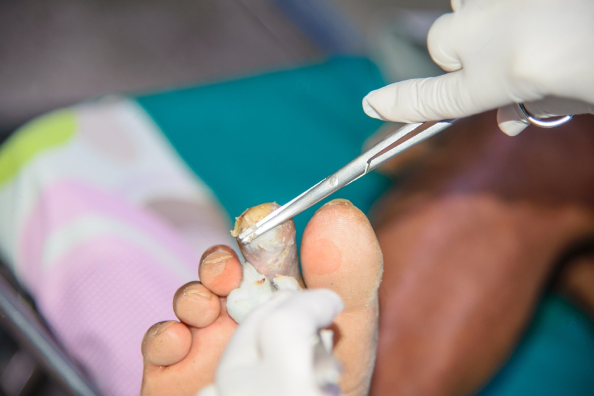 Orthopedic Treatment for Necrotic Foot Effective Approaches for Recovery