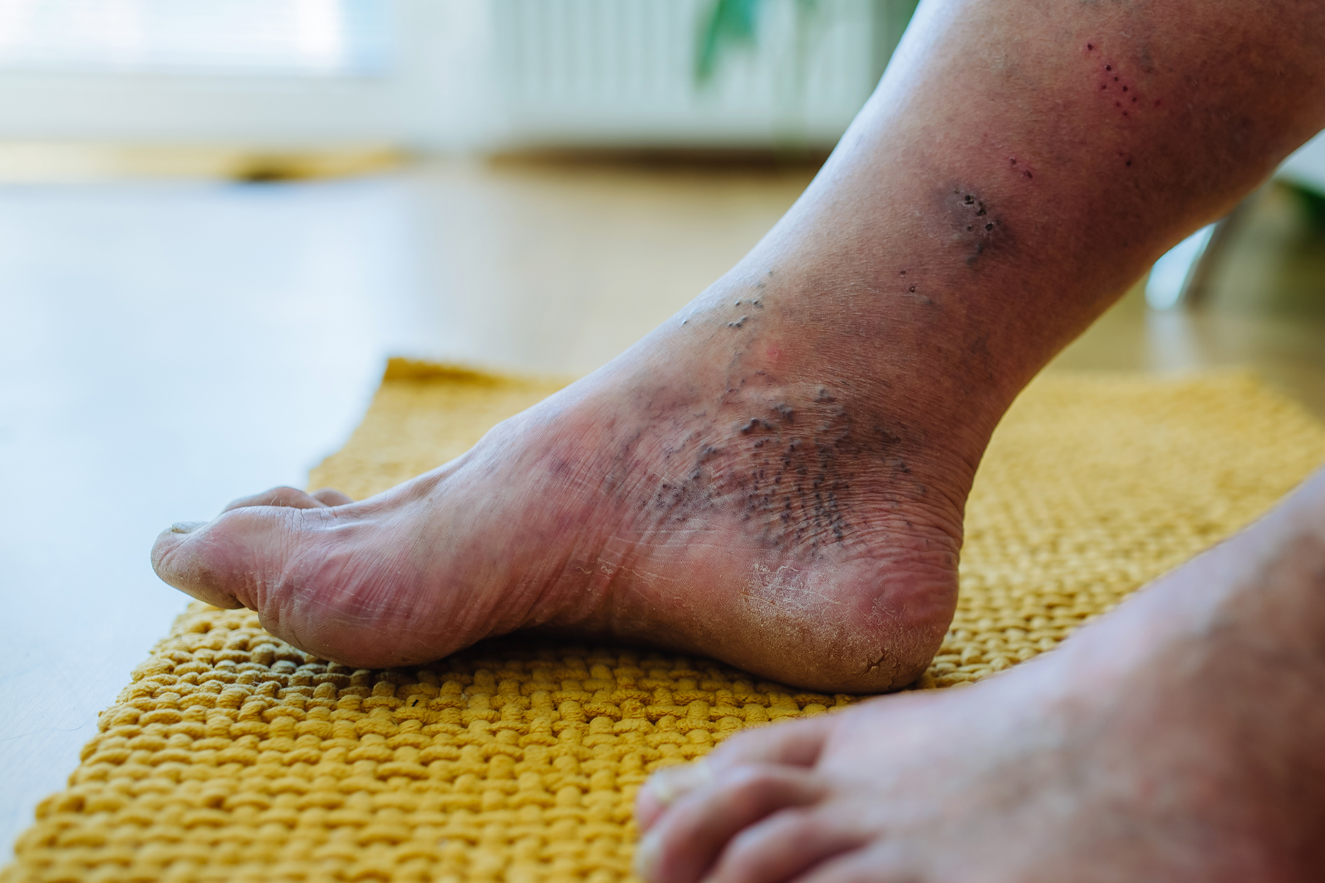 Comprehensive Diabetic Foot Ulcer Management Prevention, Treatment, and Long-Term Care