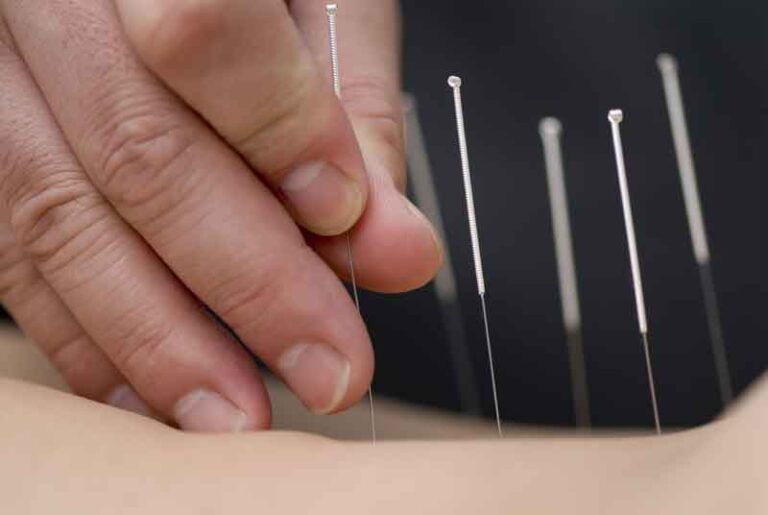 Dry Needling Treatment in Fishers A Modern Approach to Muscle Pain Relief and Recovery
