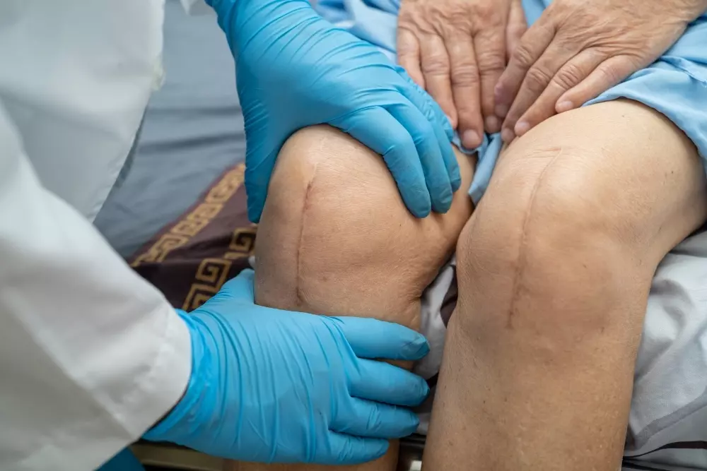 Total Knee Replacement What to Expect, How It Works, and Life After Surgery